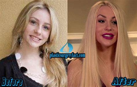 Courtney Stodden Plastic Surgery Before And After Photos Plastic Surgery Courtney Stodden
