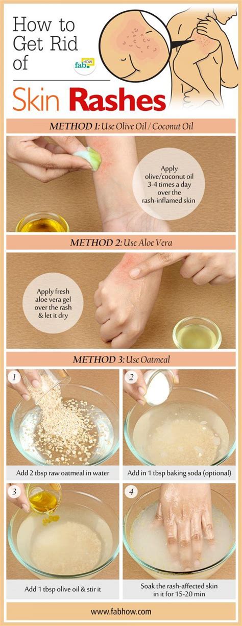 View How To Get Rid Of Rash On Hands To Their