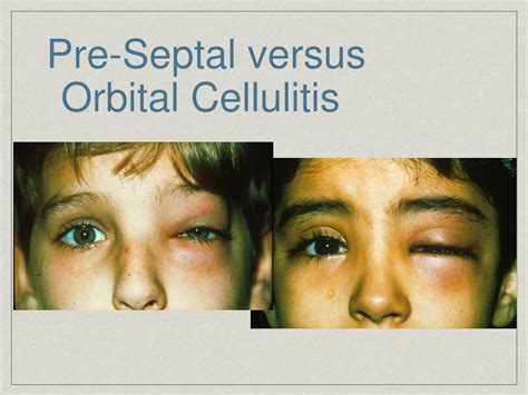 Preseptal Versus Orbital Cellulitis