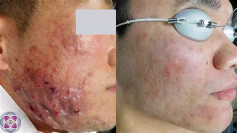 Red Light Therapy Acne Scars Before And After