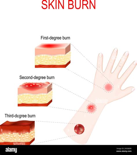 Types Of Burns Cross Section Of Humans Skin With First Second And
