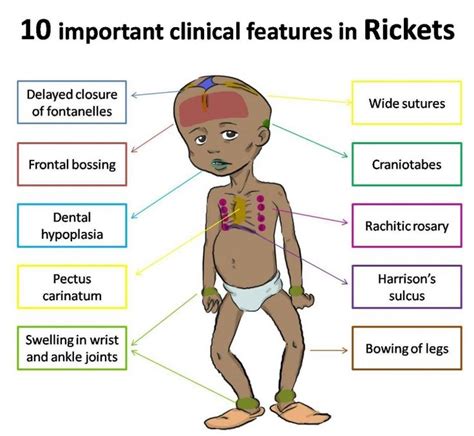 Clinical Features Of Rickets Pediatric Nursing Kids Health Nursing
