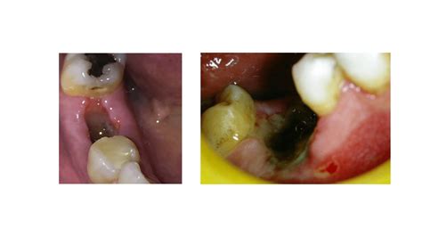 Dry Socket The Most Common Complication After Tooth Extraction