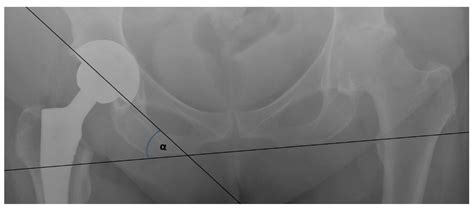 Jcm Free Full Text The Direct Anterior Approach To Primary Total