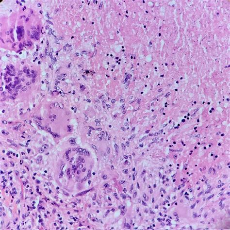 Pathology Outlines Tuberculosis