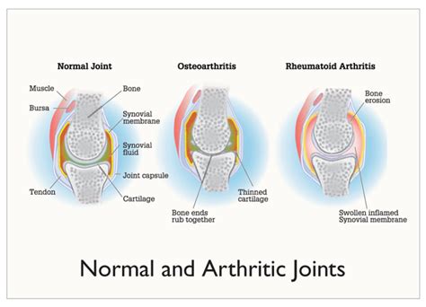 Osteoarthritis And Rheumatoid ­arthritis 2012 Pathophysiology