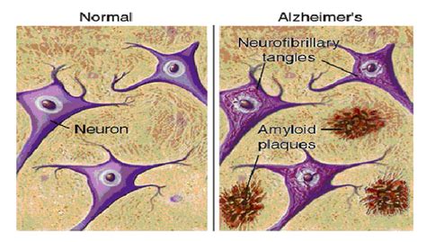 A Promising Cure For Alzheimers Disease Columbia Science Review