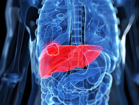 Lung tumors have moderate to high potential for metastasis (spreading). How Lung Cancer Spreads to the Liver