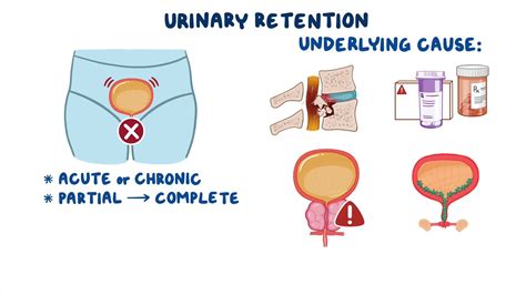 Urinary Retention Clinical Sciences Osmosis Video Library