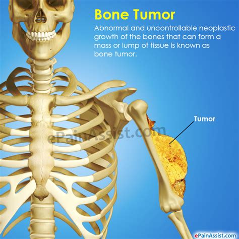 Bone Tumortypessymptomstreatmentsurvival Period