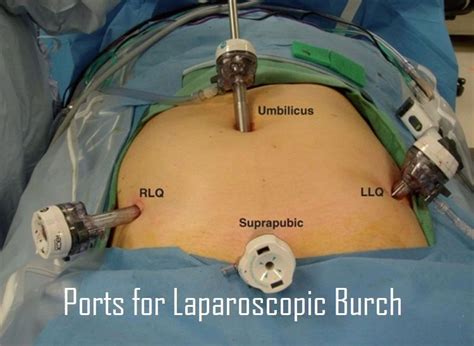 Port Position Of Various Laparoscopic Gynecological Surgeries My Xxx Hot Girl