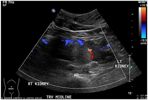 A Horseshoe Kidney With Solid Mass A Case Report Shannon Thoma
