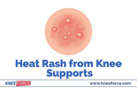 Itchy Rash From A Knee Brace › Knee Force