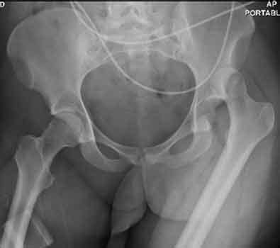 The hip can dislocate forward or backward (anteriorly or posteriorly). Skeletal Trauma