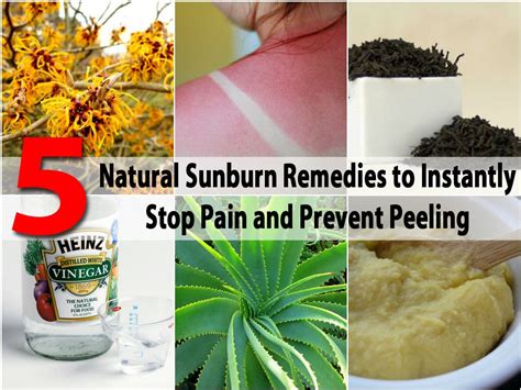 5 Natural Sunburn Remedies To Instantly Stop Pain And Prevent Peeling