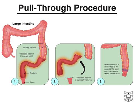 ask the doctor hirschsprung disease with dr baddr shakhsheer department of surgery