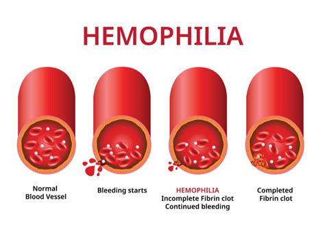 First Potential Gene Therapy For Hemophilia B Restores Blood Clotting