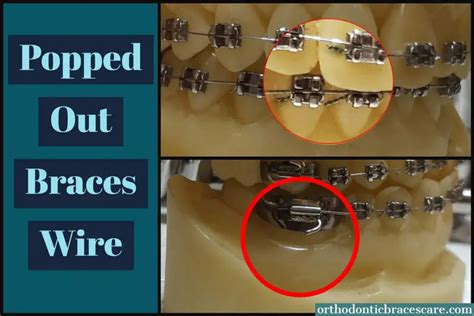 Braces Wire Popped Out Of Bracket Causes What To Do Orthodontic Braces Care