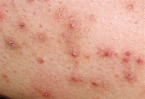 Children's Bacterial Skin Infections - Diagnosis and ...