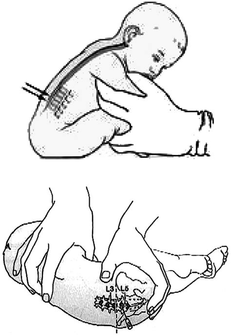 Needle Positions For Lumbar Puncture Download Scientific Diagram