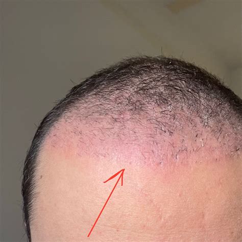bald spots hair restoration questions and answers hair restoration network community for