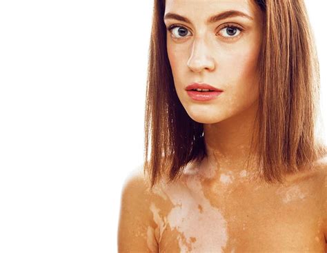 What Is Vitiligo And How Can You Treat It Recouleur® Vitamins For