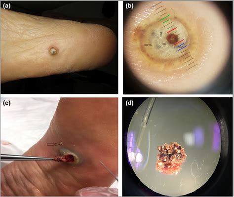 Image Gallery Tungiasis In Four Steps El Habnouni British Journal Of Dermatology