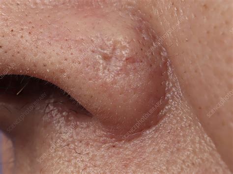 Basal Cell Carcinoma Of The Nasal Wing Stock Image C050 7421
