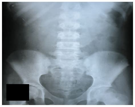 X Ray Of The Abdomen Showing Diffuse Fecal Loading Download