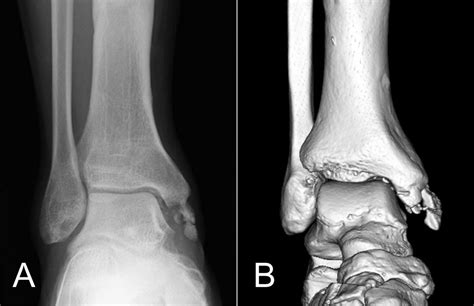 Best Avulsion Fracture Images Avulsion Fracture Sprained Ankle My XXX