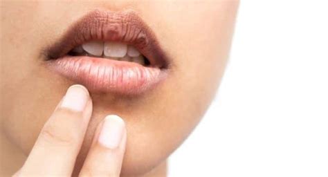 Black Spots On Lips Causes Lipstutorial Org