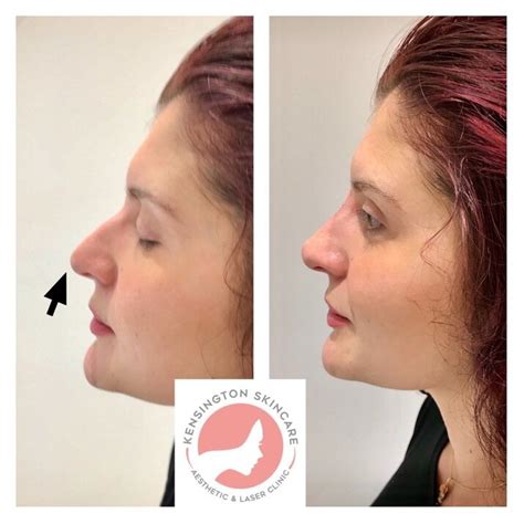 Free Consultation Non Surgical Rhinoplasty At Kensington Skincare In