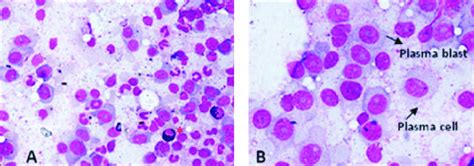 Plasma Cell Infiltrate In Bone Marrow Plasma Cells Constitute 80 90