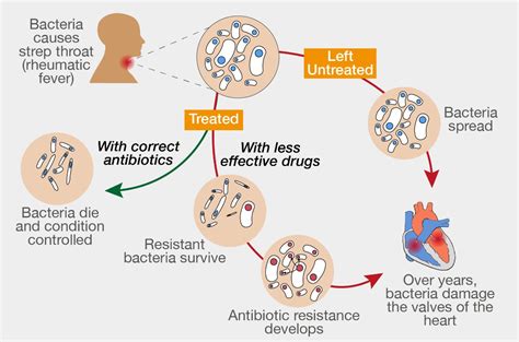 If treated with the wrong antibiotics, rheumatic fever can lead to