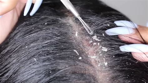 This treatment can be used for split ends, dry scalp, hair moisturizer, dry hair, taming frizz, deep condition, thinning hair, dandruff, bald spots and most importantly, grow your hair thick and healthy. Onion Therapy for the Treatment of Dandruff. | My Naija ...