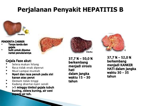 Beda dengan hepatitis b dan c, infeksi hepatitis a tidak menyebabkan penyakit hati kronis dan jarang sekali menjadi fatal. Apa Itu Hepatitis Akut - Resep Kuini