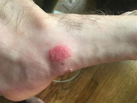 Itchy Rash On Foot With Small Blisters Forming Dermatology