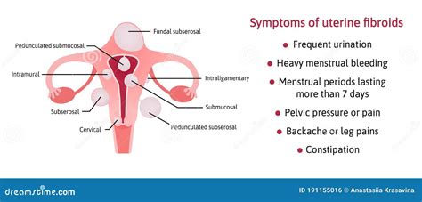 Uterine Fibroids And Its Symptoms List Of Symptoms Different Locations Inside Womb Subserosal