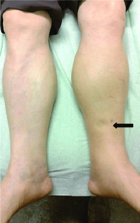Severe Pitting Oedema Of The Left Leg At Initial Presentation The