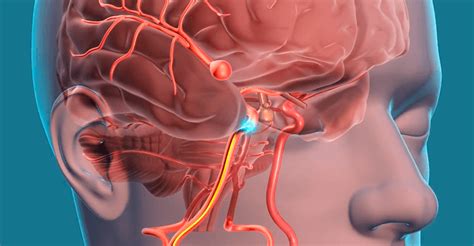 Dificilmente uma a pessoa já nasce com um aneurisma. Aneurisma Cerebral | Saiba as causas e tratamentos