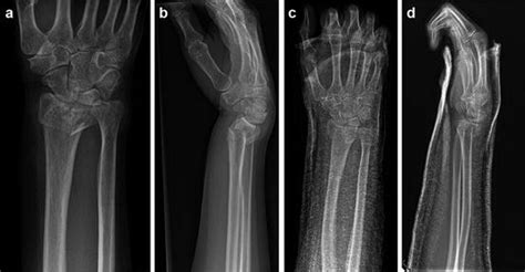 Distal Radius Fracture: Kapandji (Intrafocal) Pinning ...