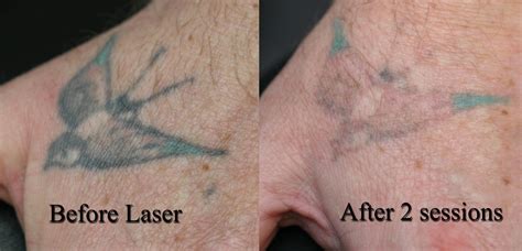 The first one cost me $200, but that was about 10 years ago and is a simple tattoo (took about 45 mins) my other one is a more complicated arm band that was custom designed for me. How much does an average tattoo removal cost rentokil ...