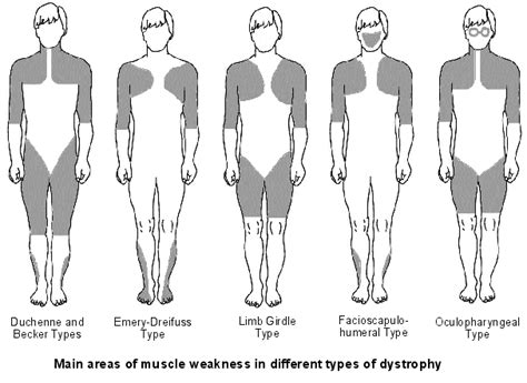 Treatment for Muscular Dystrophy - Now possible through Homeopathy