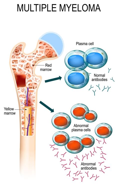 Another cancer that starts in the bone marrow is leukemia. Two immunotherapy approaches for multiple myeloma show hope