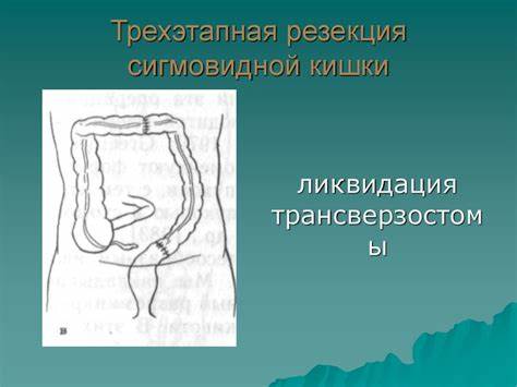Дивертикулез сигмовидной кишки диеты Дивертикулез ободочной кишки - презентация онлайн Дивертикулез ободочной кишки - презентация онлайн Дивертикулез сигмовидной кишки диеты