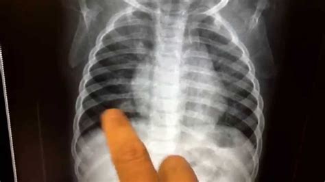 Early Pneumonia In A Pediatric Patient Youtube
