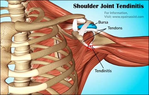 What Is Shoulder Joint Tendinitis Causes Symptoms Treatment Prognosis