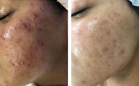 Acne Facial Scarring Treatment Neutral Bay Sydney Lab