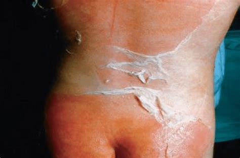Staphylococcal Scalded Skin Syndrome Note The Extensive