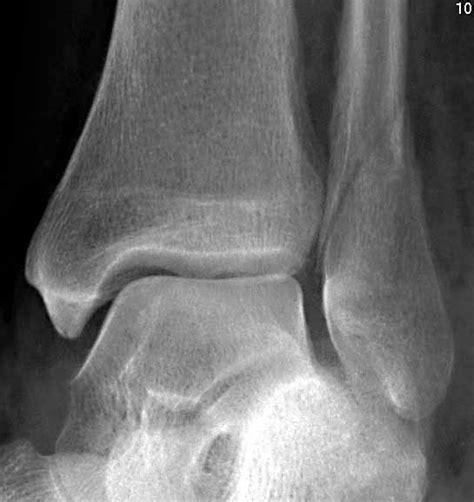 Three Week Versus Six Week Immobilisation For Stable Weber B Type Ankle